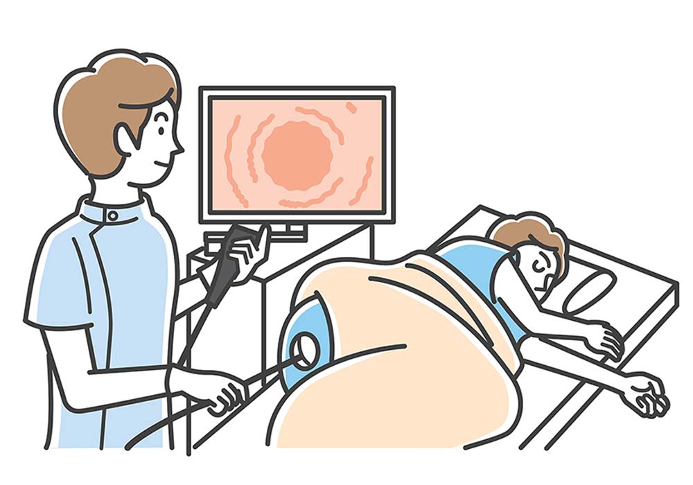 下部消化管内視鏡検査(大腸カメラ)